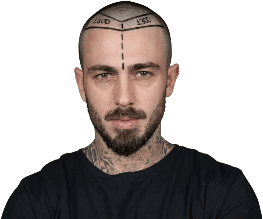 Hair transplant patient with the planned graft areas marked on his scalp