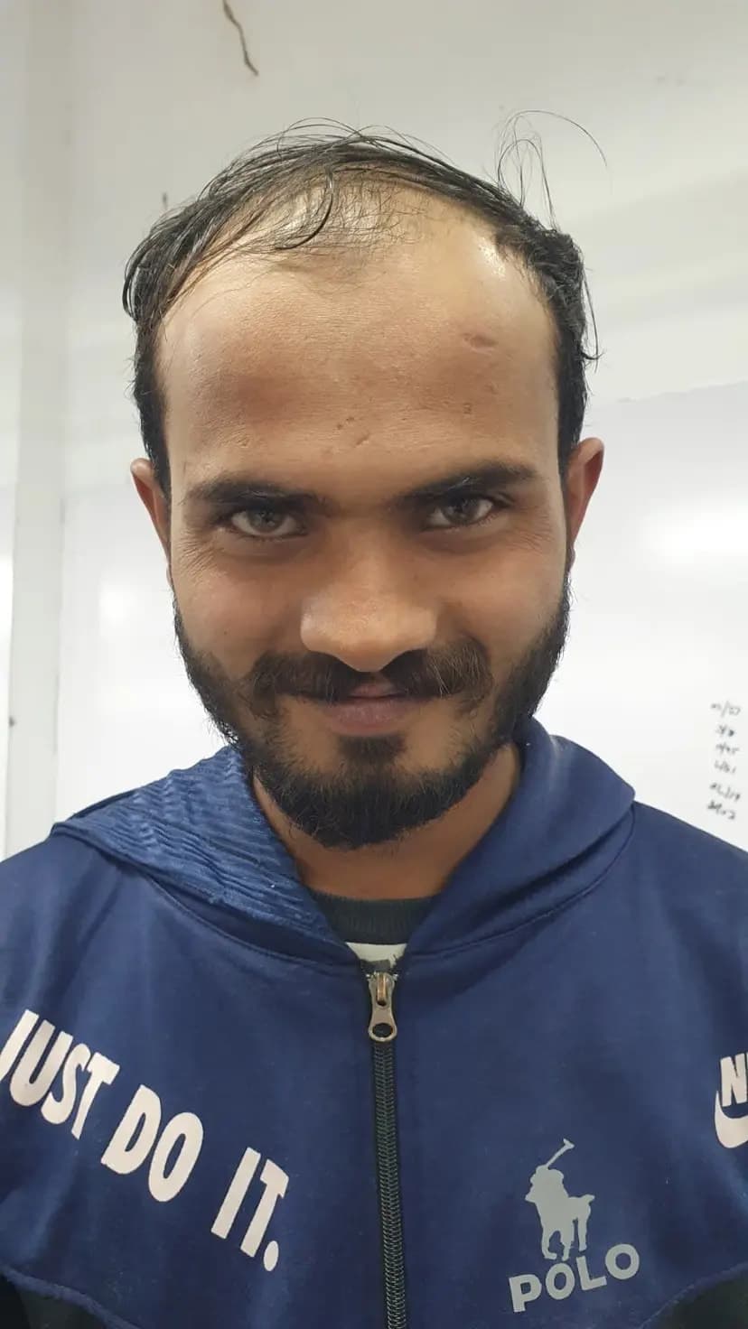 Front and Crown Restoration — before FUE Chinese Method