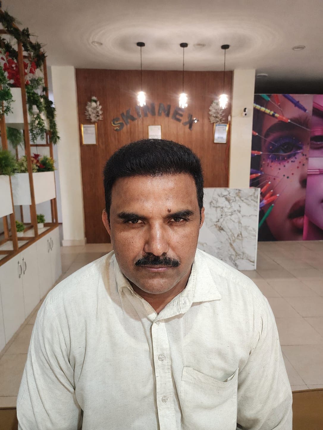 Front and Mid Crown Hair Transplant — after FUE Chinese Method