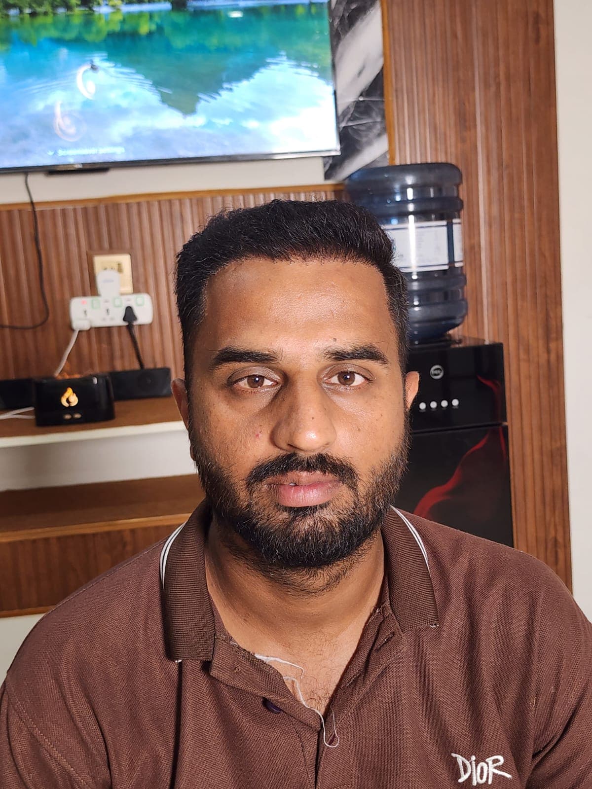 Front Hair Line Restored — after FUE Chinese Method