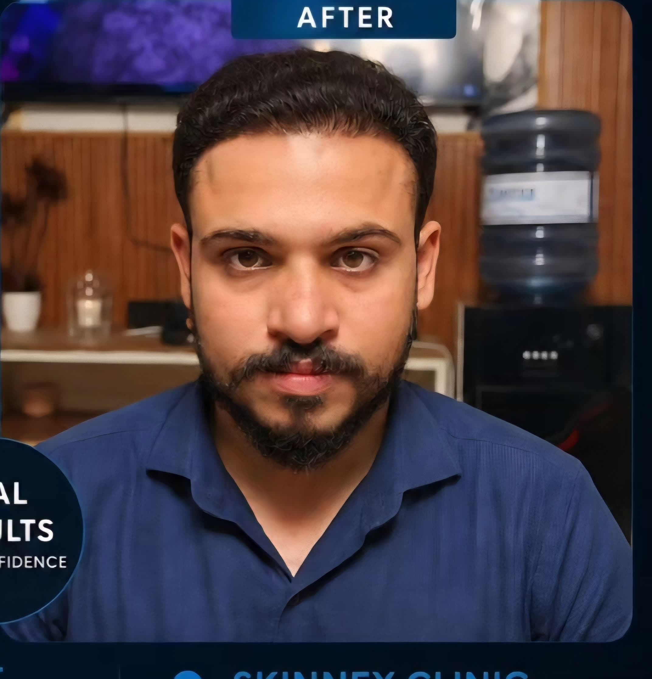 Front Hair Line Restored — after FUE Turkish Method