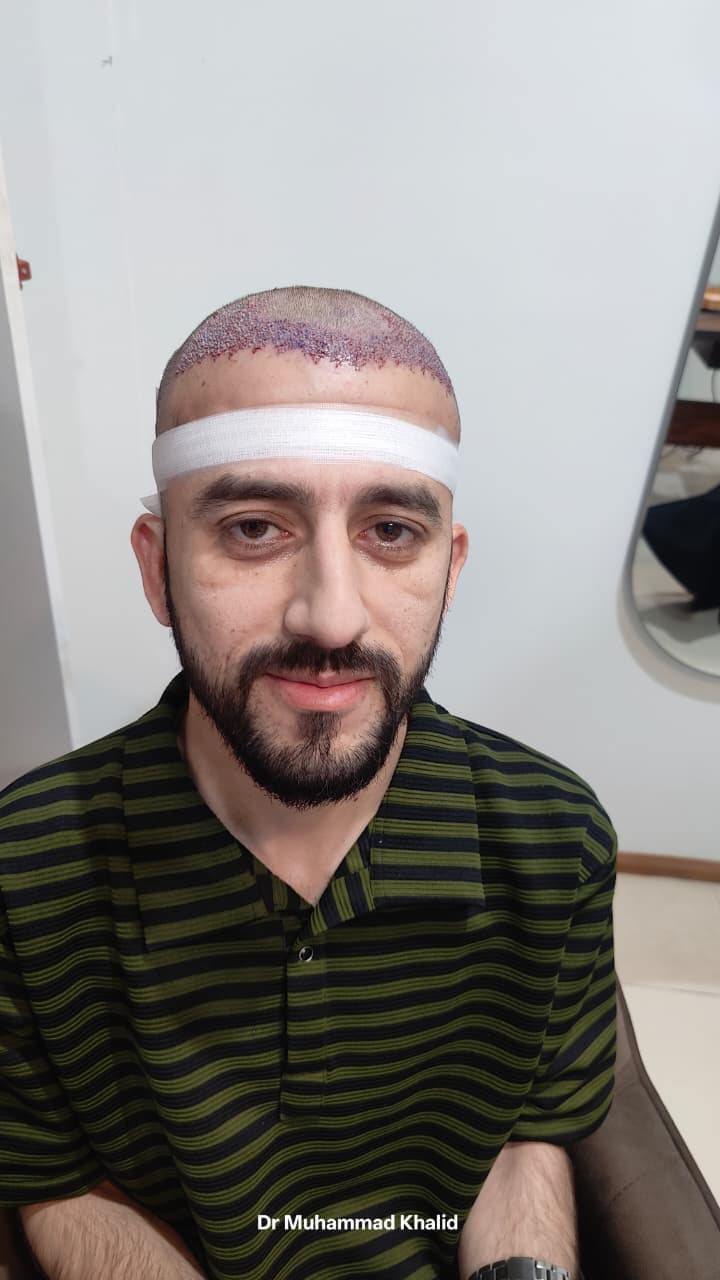 Front Hairline and Crown — before FUE Chineese Method