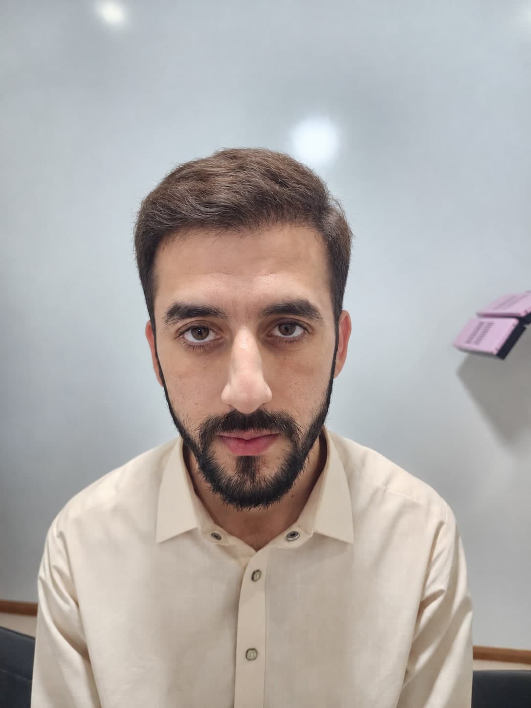 Front Hairline and Crown — after FUE Chineese Method