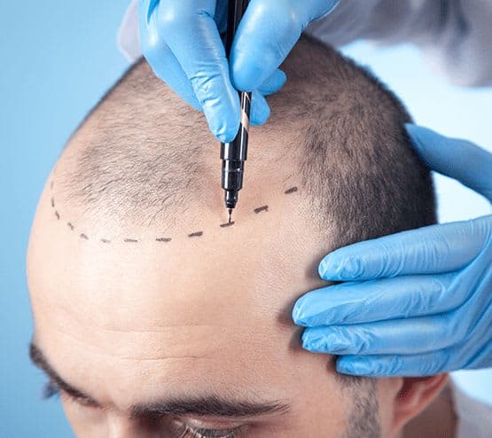 FUE hair transplant procedure at a professional hair restoration clinic in Lahore