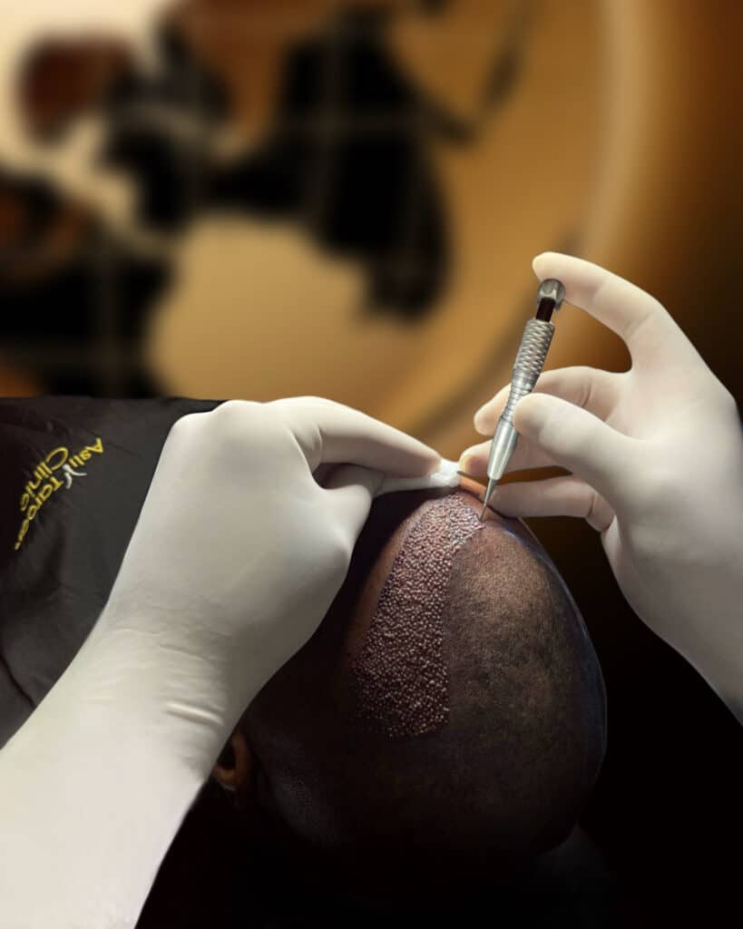 DHI hair transplant procedure at Skinnex Clinic in Lahore
