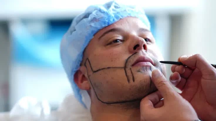 Beard hair transplant procedure at Skinnex Clinic in Lahore