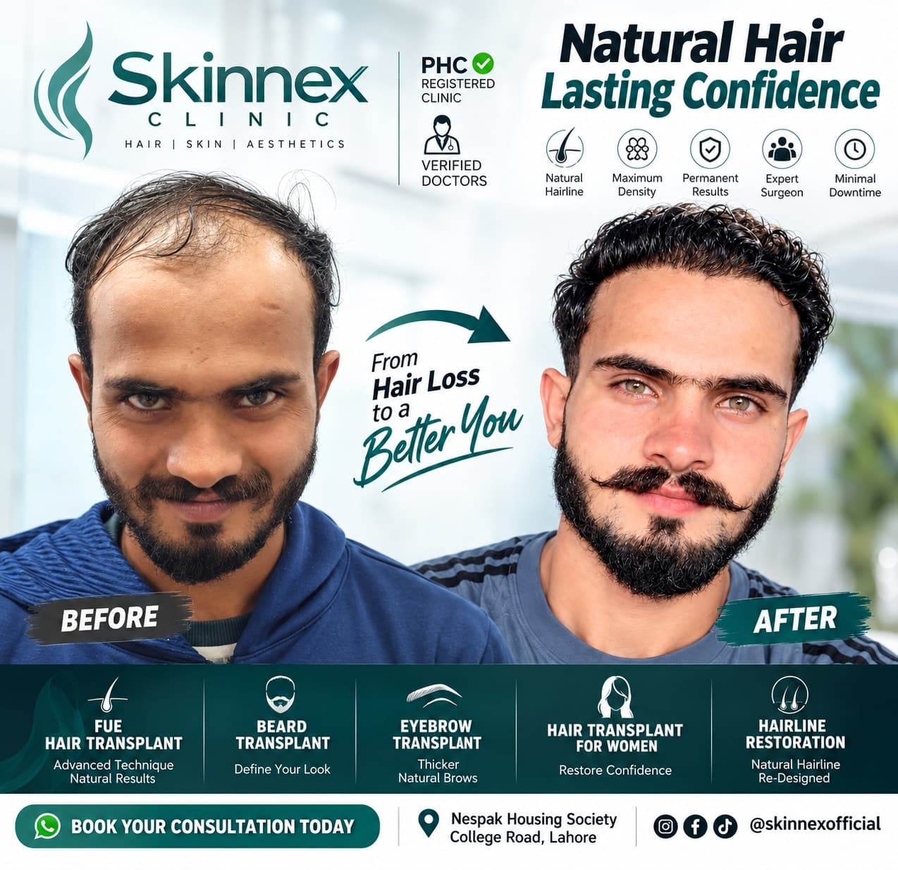 Hair transplant procedure and long-term hair restoration at a professional hair clinic