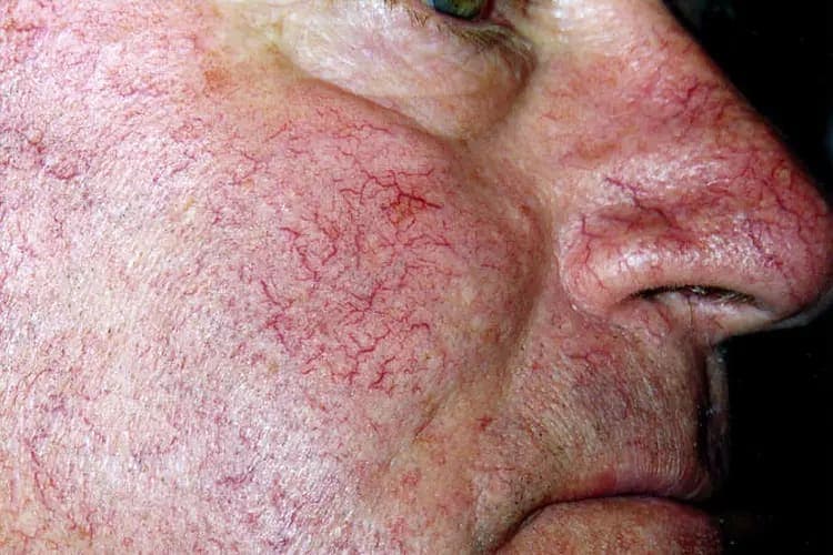 Telangiectasias are clusters of small, widened blood vessels which develop near the surface of the skin of mucous membranes. They are commonly known as spider veins. (Photo Credit: DermNet NZ)