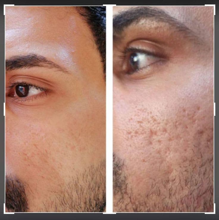 Face PRP treatment being performed at a professional aesthetic clinic in Lahore